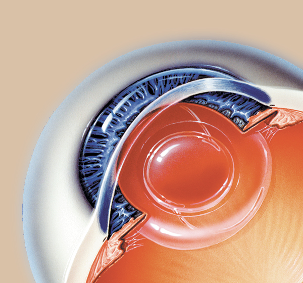 Étape 4 : La nouvelle lentille se déplie et remplace le cristallin vieilli.<br /> Le processus de guérison naturelle de l’œil commence alors immédiatement.